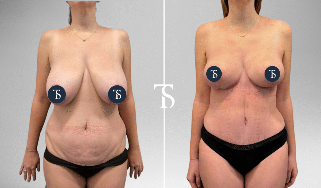 Avant après réduction mammaire