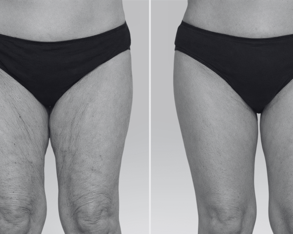 lifting cuisse avant après​