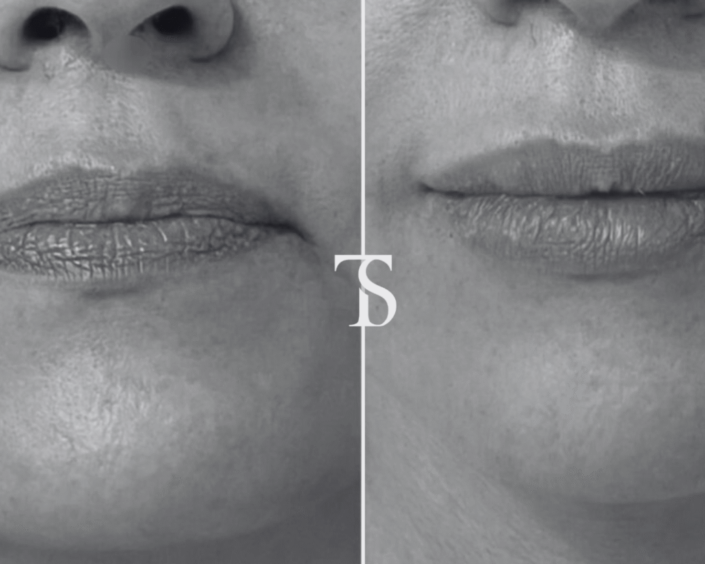 injection acide hyaluronique paris​