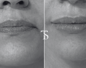 injection acide hyaluronique paris​