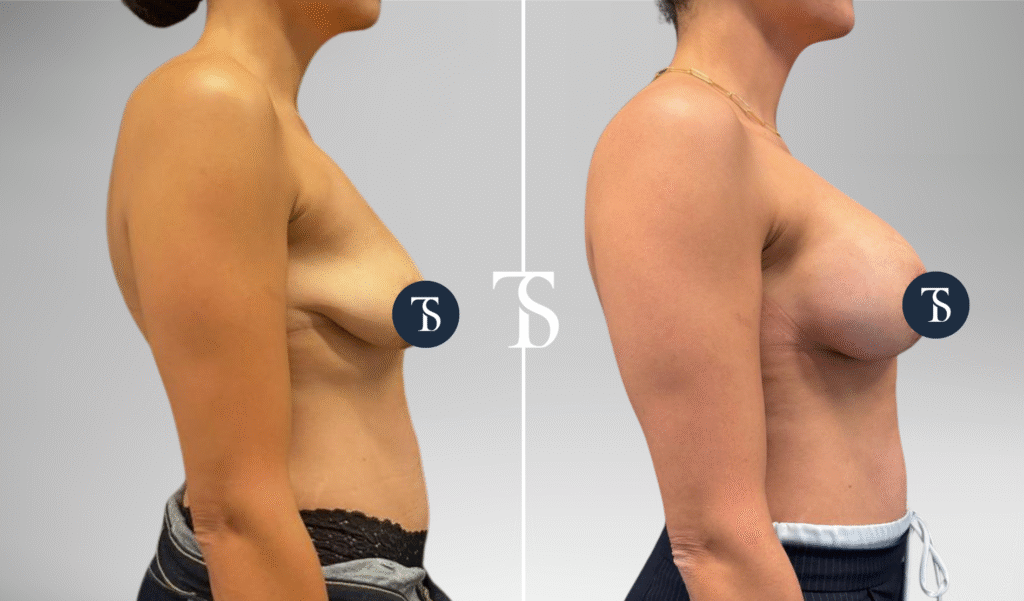 Augmentation mammaire