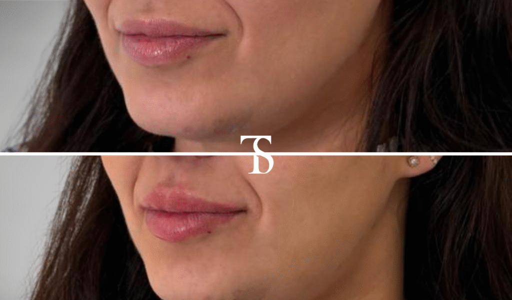 injection acide hyaluronique paris​