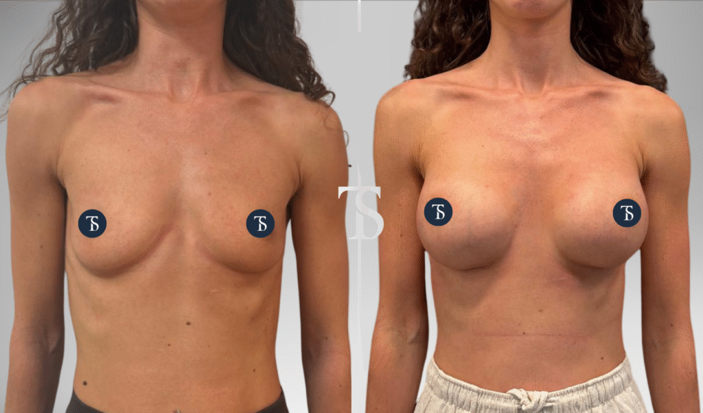 Augmentation Mammaire par prothèses