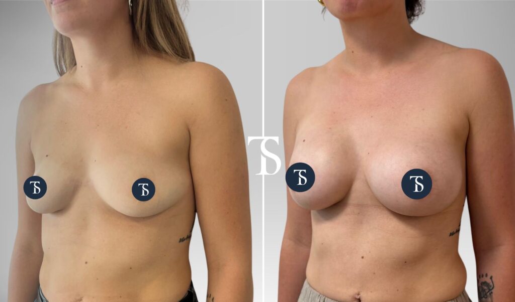 Augmentation mammaire