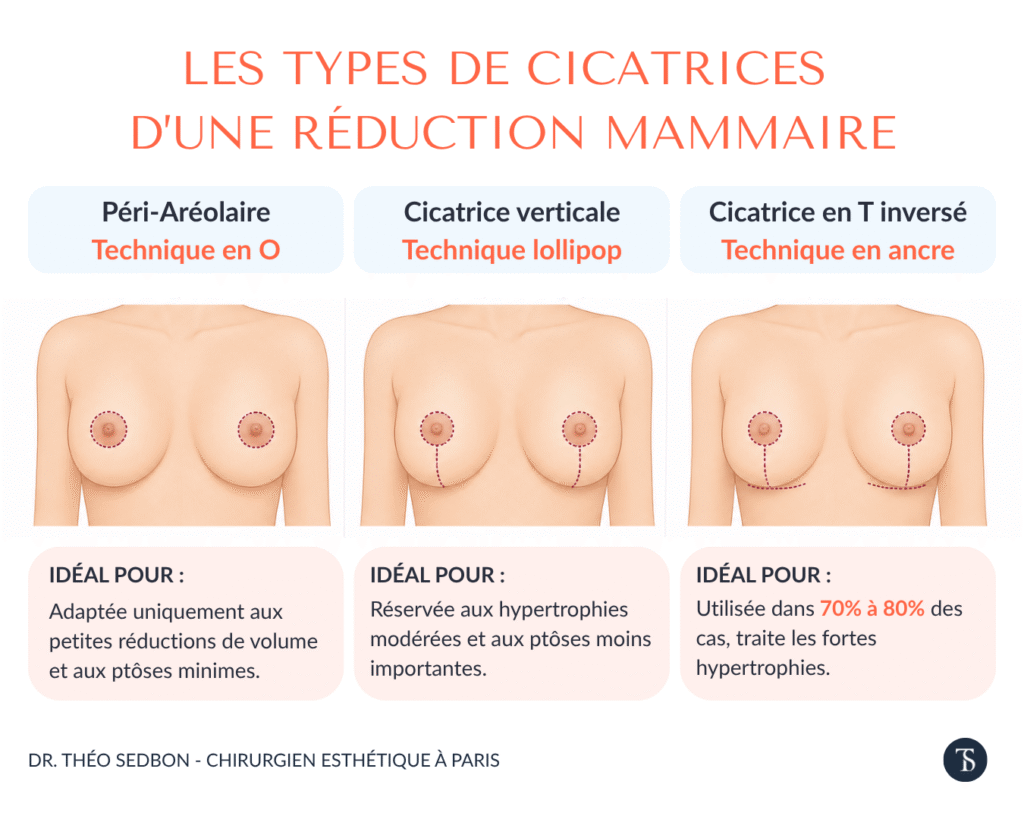 différentes cicatrice réduction mammaire 