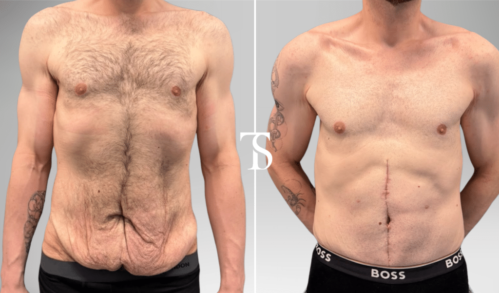 abdominoplastie avant après