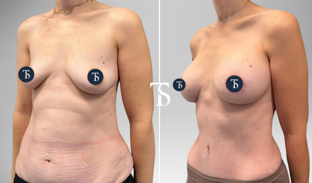 Pose de prothèses mammaires et abdominoplastie avant après