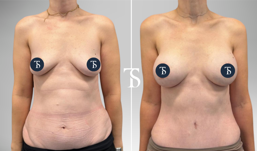 Pose de prothèses mammaires et abdominoplastie avant après