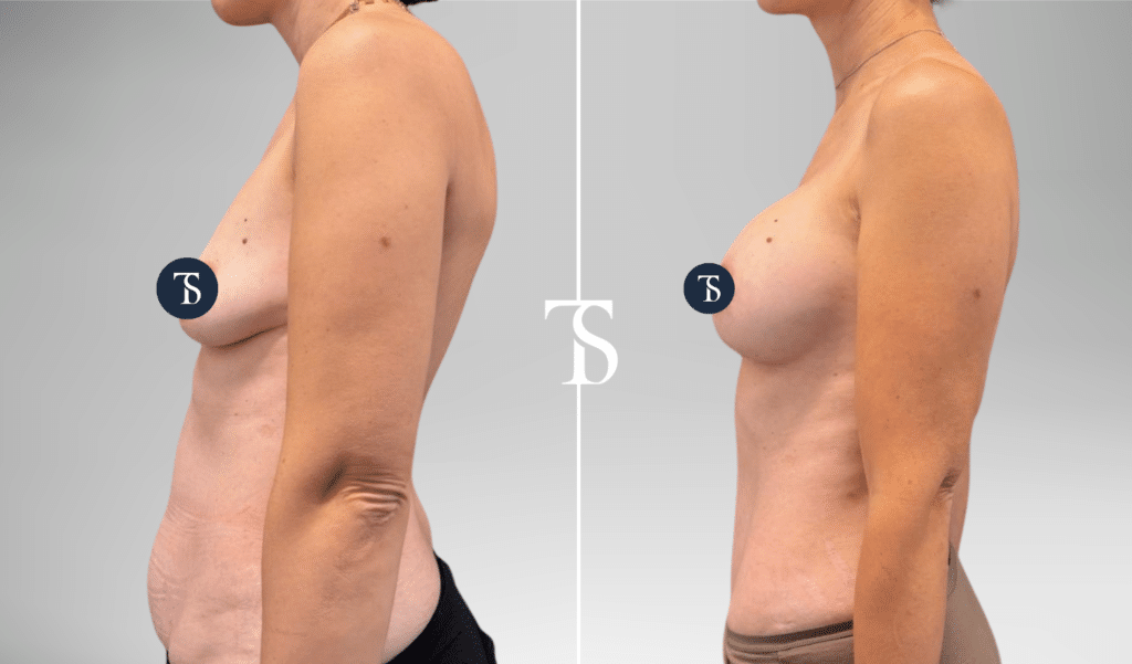Pose de prothèses mammaires et abdominoplastie avant après