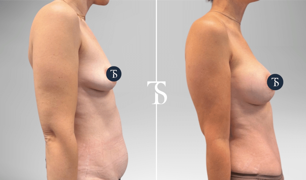Pose de prothèses mammaires et abdominoplastie avant après