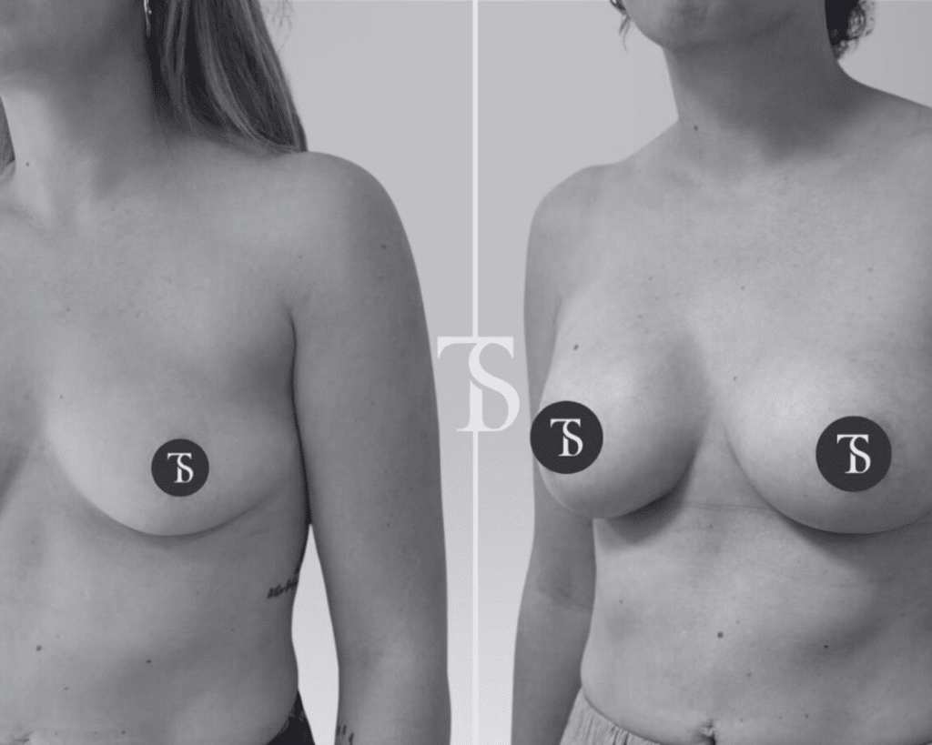 augmentation mammaire naturelle avant après​