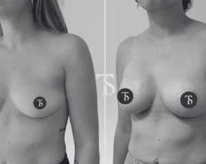 augmentation mammaire naturelle avant après​