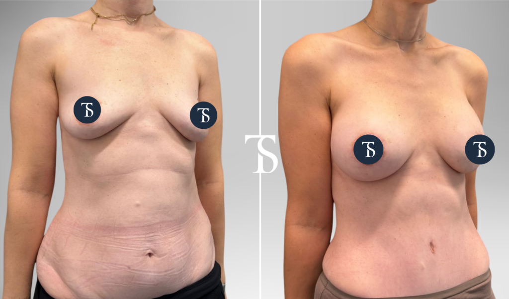 Pose de prothèses mammaires et abdominoplastie avant après
