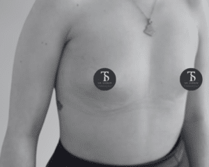 augmentation mammaire prise en charge