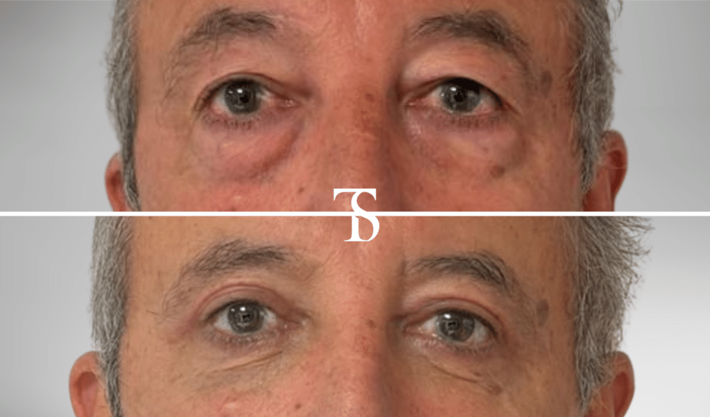 Blépharoplastie inférieure et supérieure